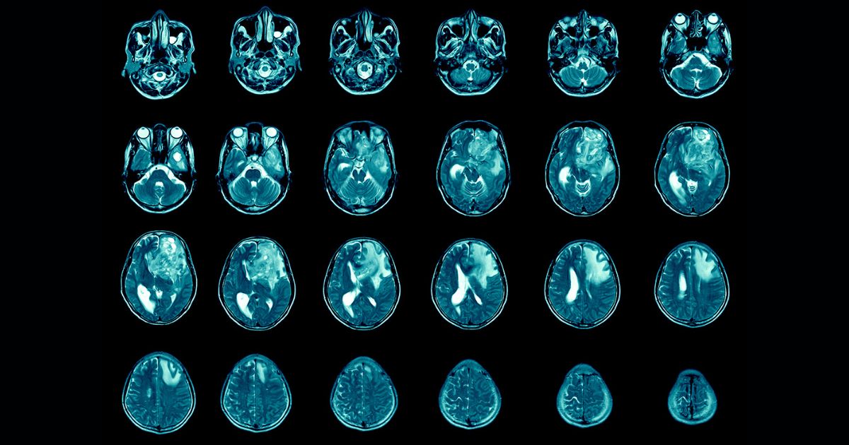 Glioblastoma é um câncer cerebral com alta taxa de mortalidade