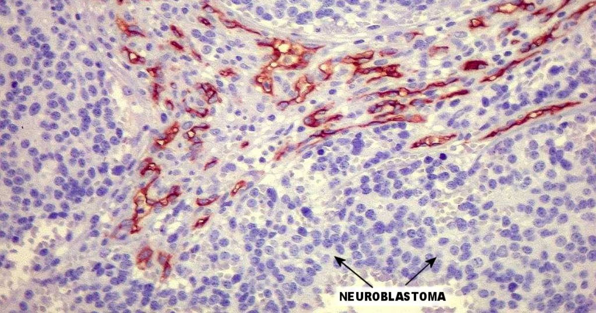 Mulher precisou passar por duas cirurgias para retirar câncer raro