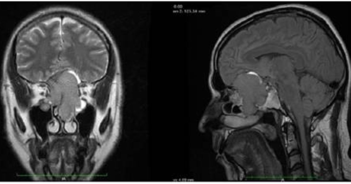 Neuroblastoma olfatório é um câncer raro