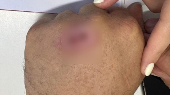 Doença que atinge humanos e gatos tem caso confirmado em cidade de SC