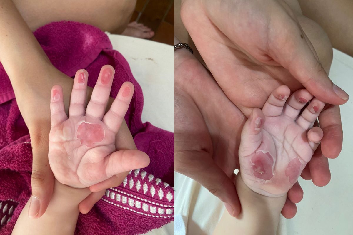 Família de bebê que sofreu queimadura de 2º grau em creche de SC entra com ação na Justiça