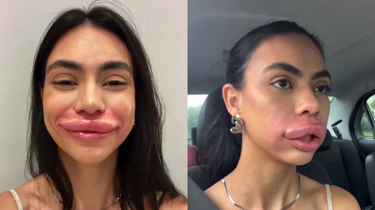 O que é hialuronidase? Substância viraliza após reação extrema em miss de SC