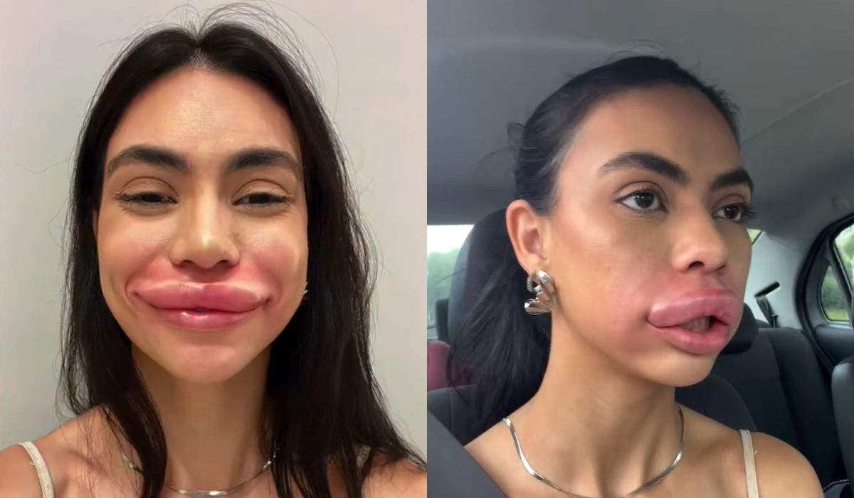 O que é hialuronidase? Substância viraliza após reação extrema em miss de SC