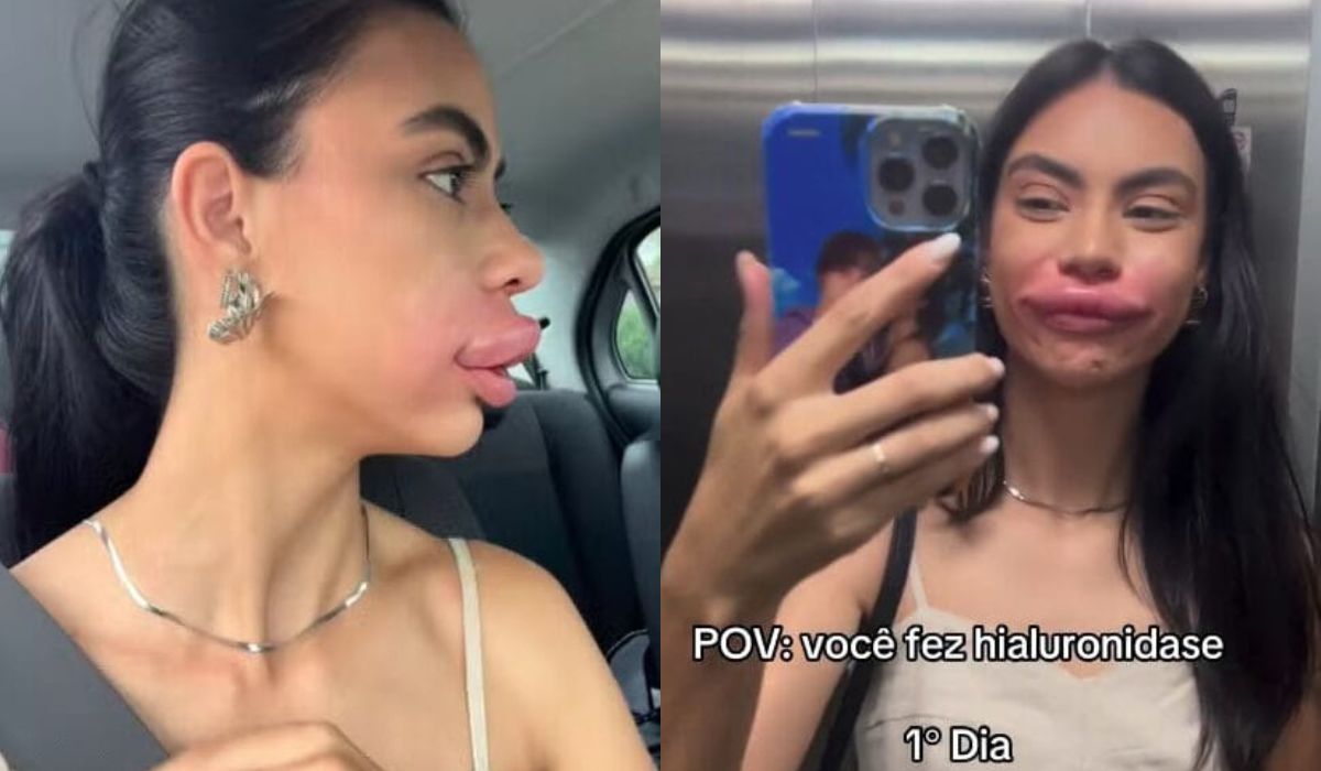 Miss sofre reação extrema após procedimento estético em SC: ‘Foi bem exagerado’