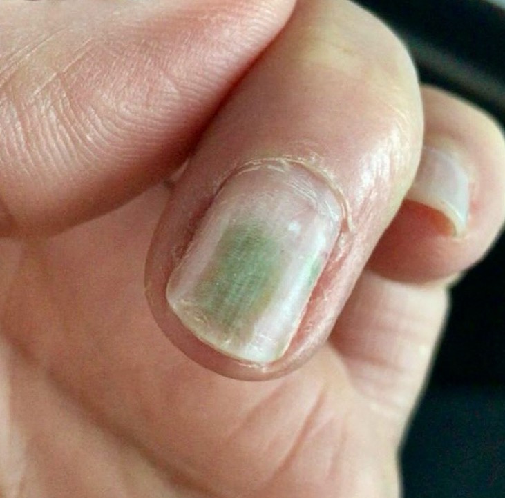 A popularmente conhecida como unha verde é um dos sintomas provocados pela ambientação desse tipo de bactéria nas unhasFoto: Reprodução @musa.nailart / ND Mais