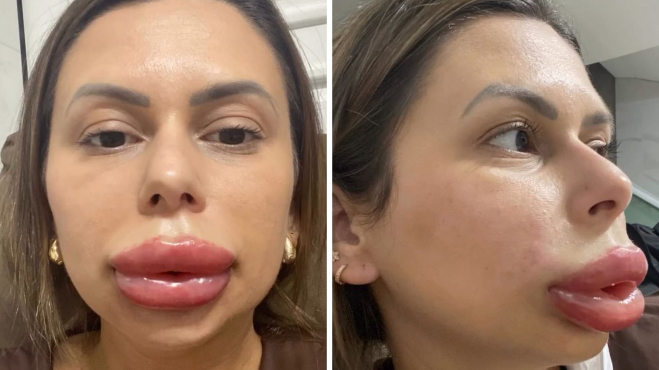 Confeiteira de Florianópolis com os lábios extremamente inchados devido a um preenchimento labial