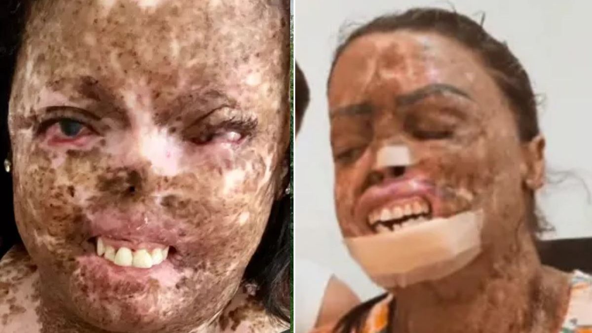 Doença Rara: Cidade Brasileira Lidera Casos Mundiais de Xeroderma Pigmentoso