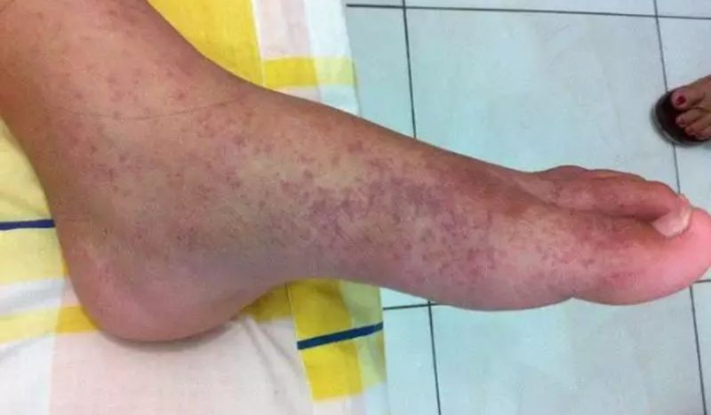 Chikungunya - Reprodução/ND Mais