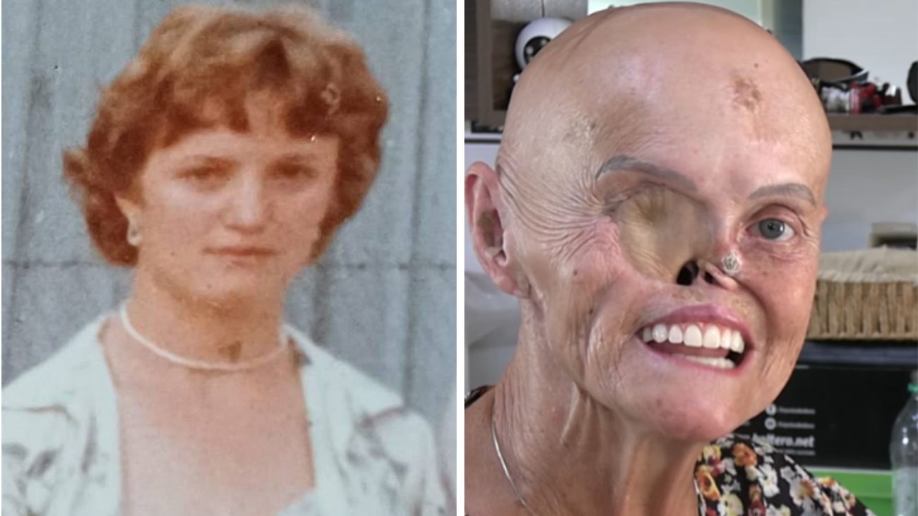 Hilária Mireski antes e depois de descobrir a doença rara e se submeter a cirurgiasFoto: Arquivo pessoal/ND Mais