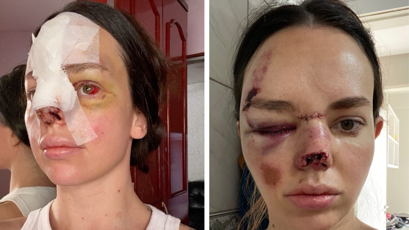 Após perder parte da estrutura do nariz, Alessandra Schäffer segue em reconstrução facial com novas cirurgias previstas. Foto: Arquivo pessoal/ND Mais