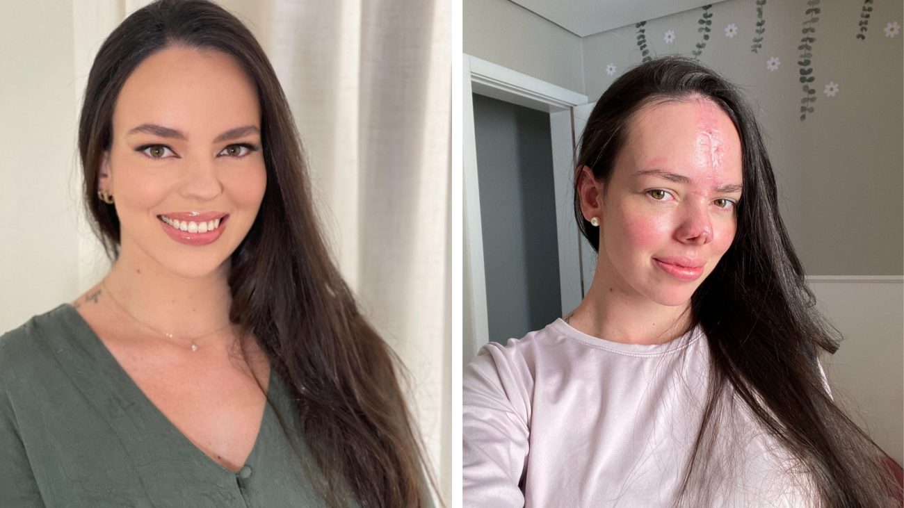 Imagem de antes e depois de Alessandra Schäffer que compartilha a jornada de reconstrução facial após acidente em SC