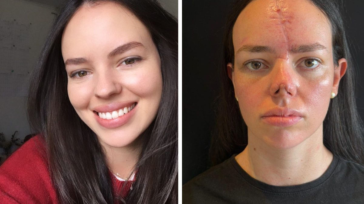 ‘Soltei o cinto para atender minha filha’: doula de SC revela detalhe de acidente que levou à reconstrução facial - QTU Questões do Universo