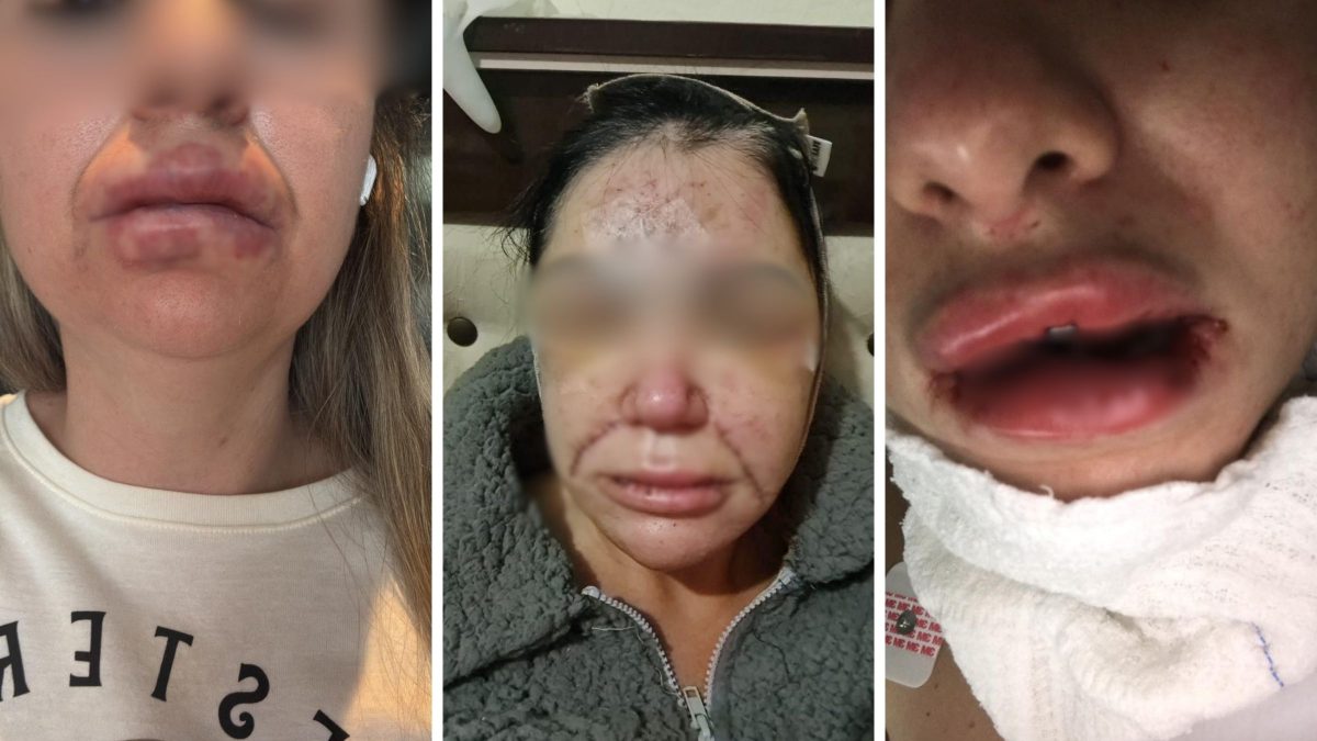 Uso de substância proibida em clínica estética de SC teria deformado rostos e necrosado bocas de clientes - QTU Questões do Universo