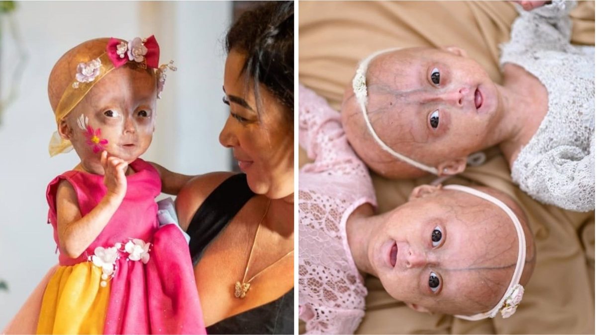 Morre aos 5 anos gêmea diagnosticada com síndrome de envelhecimento precoce: ‘A gente queria mais tempo’