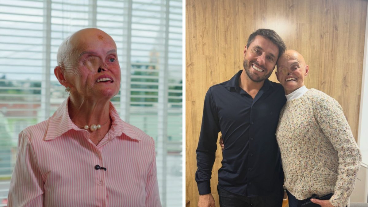 Após enfrentar 73 cânceres e perder olho e nariz, catarinense espera por reconstrução facial e desabafa sobre nova fase: ‘Gratidão’