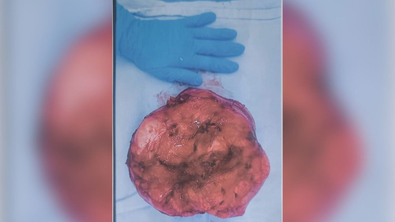 Tumor retirado do aposentado é maior do que uma mão.Foto: Arquivo pessoal/ND Mais