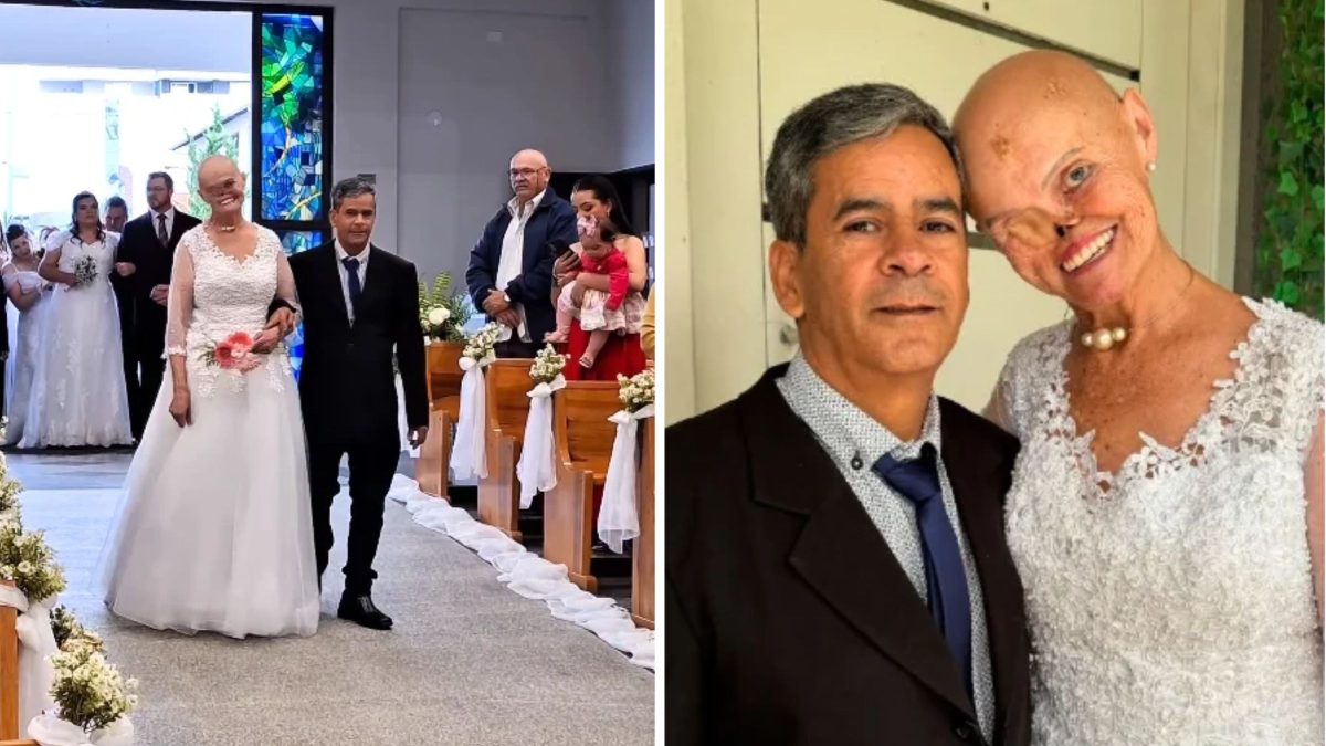 Catarinense que enfrentou 73 cânceres de pele se casa com homem que conheceu durante rotina de exames em hospital de SC