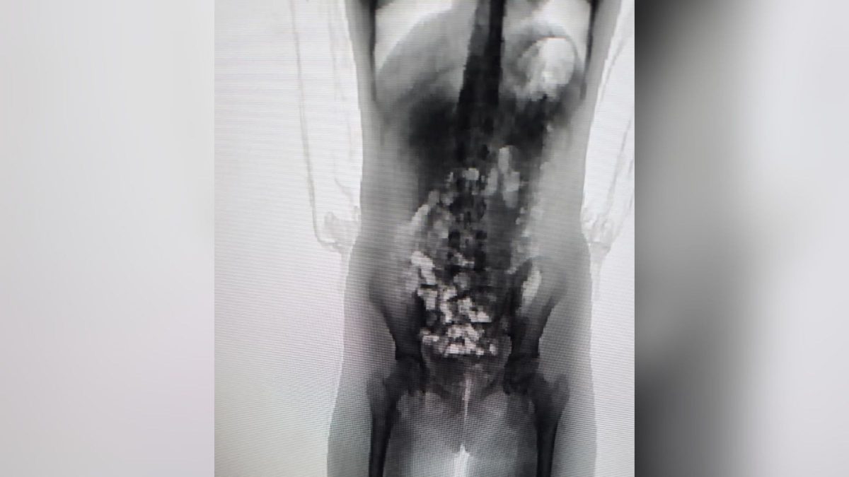 Mãe é detida após scanner corporal flagrar adolescente de 13 anos com 32 pacotes escondidos no corpo em SC