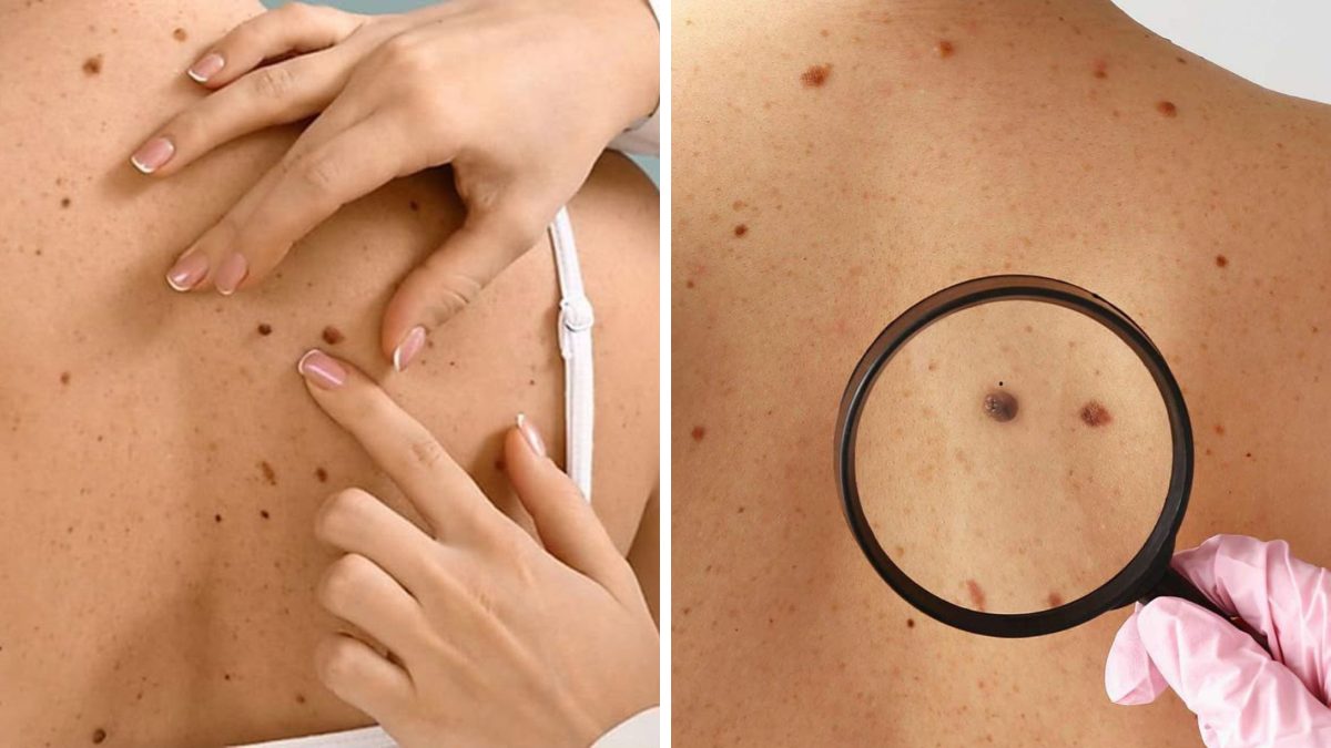 Pintas ficam mais escuras após tomar sol? Dermatologista alerta para sinais que podem indicar câncer de pele