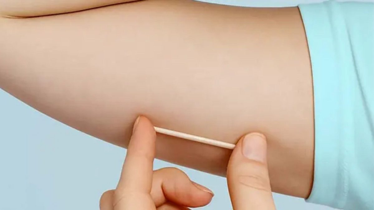 Implanon: Anvisa amplia prazo de eficácia de implante contraceptivo de 3 para 5 anos