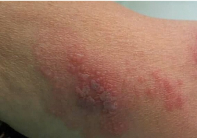 O avanço da Herpes no Brasil